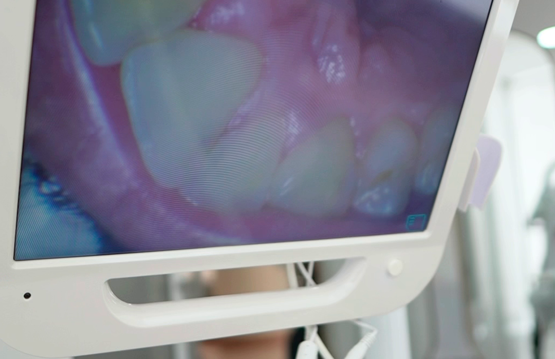 Endodoncia Microscópica en Armenia
